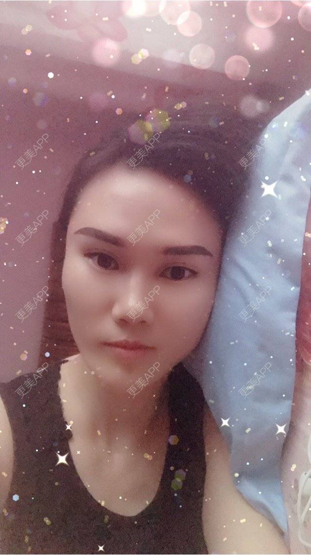 更美 - 安迪🌷的玻尿酸面颊经验 | 上海 | 玻尿酸面颊