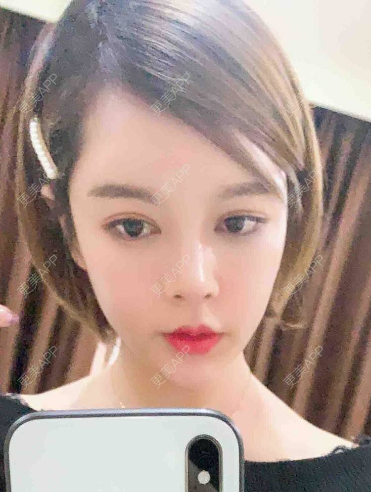 更美 - 更美用户uiIaqtaVR1的隆鼻经验 | 杭州 | 肋软骨隆鼻 | 隆鼻 | 微针水光