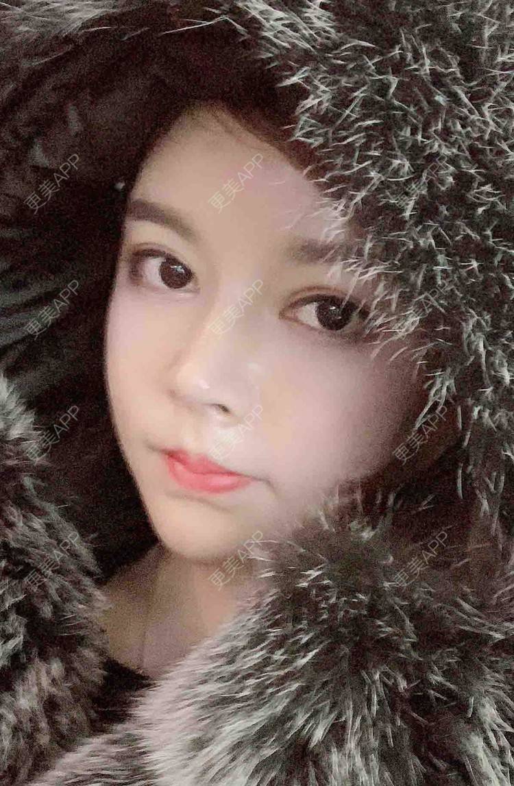 更美 - 更美用户uiIaqtaVR1的隆鼻经验 | 杭州 | 肋软骨隆鼻 | 隆鼻 | 微针水光