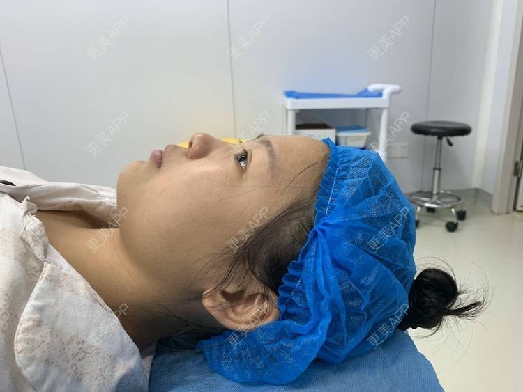 更美 - 变美找我~的肋软骨隆鼻经验 | 肋软骨隆鼻 | 鼻翼缩小 | 宁波 | 鼻孔矫正 | 眼部多项 | 自体肋软骨垫鼻基底