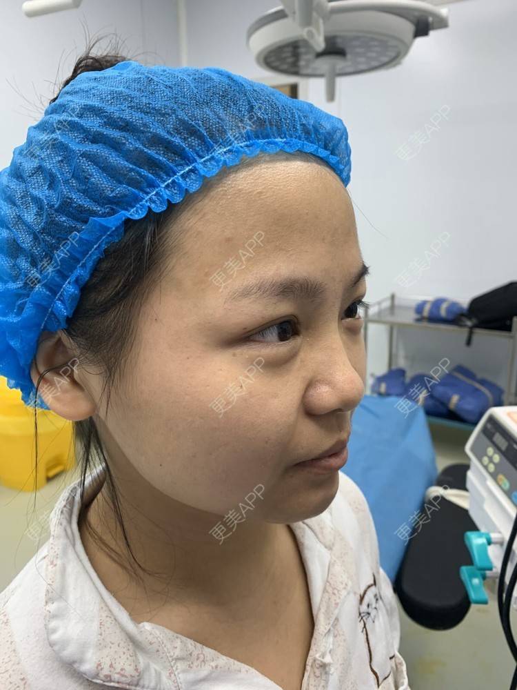 更美 - 变美找我~的肋软骨隆鼻经验 | 肋软骨隆鼻 | 鼻翼缩小 | 宁波 | 鼻孔矫正 | 眼部多项 | 自体肋软骨垫鼻基底