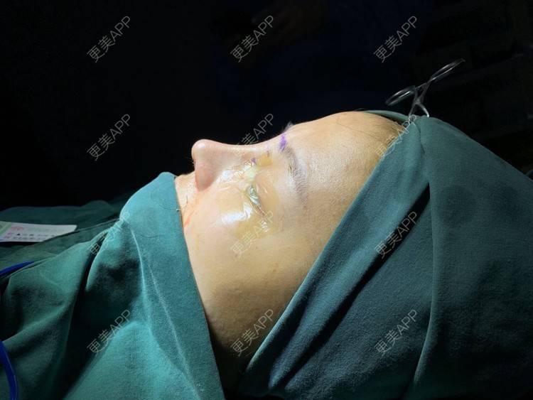 更美 - 变美找我~的肋软骨隆鼻经验 | 肋软骨隆鼻 | 鼻翼缩小 | 宁波 | 鼻孔矫正 | 眼部多项 | 自体肋软骨垫鼻基底