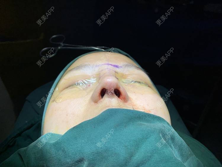 更美 - 变美找我~的肋软骨隆鼻经验 | 肋软骨隆鼻 | 鼻翼缩小 | 宁波 | 鼻孔矫正 | 眼部多项 | 自体肋软骨垫鼻基底