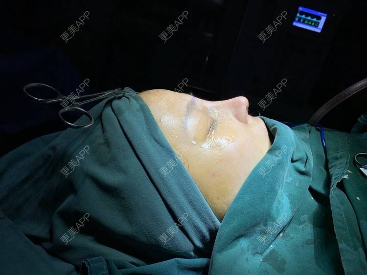 更美 - 变美找我~的肋软骨隆鼻经验 | 肋软骨隆鼻 | 鼻翼缩小 | 宁波 | 鼻孔矫正 | 眼部多项 | 自体肋软骨垫鼻基底