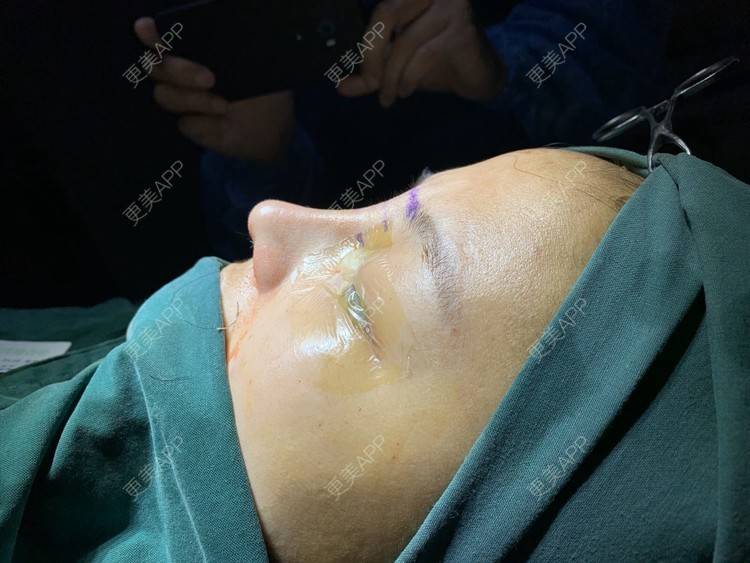 更美 - 变美找我~的肋软骨隆鼻经验 | 肋软骨隆鼻 | 鼻翼缩小 | 宁波 | 鼻孔矫正 | 眼部多项 | 自体肋软骨垫鼻基底