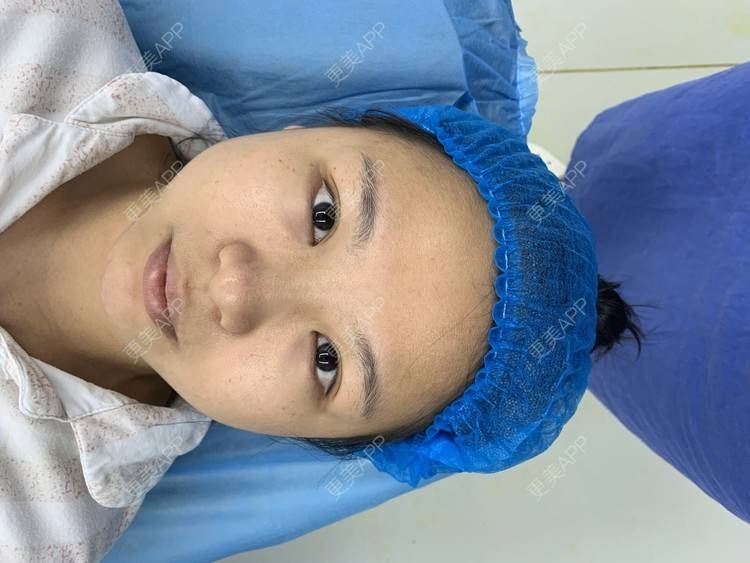 更美 - 变美找我~的肋软骨隆鼻经验 | 肋软骨隆鼻 | 鼻翼缩小 | 宁波 | 鼻孔矫正 | 眼部多项 | 自体肋软骨垫鼻基底