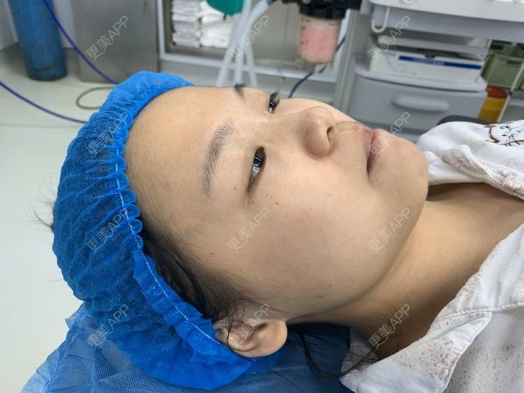 更美 - 变美找我~的肋软骨隆鼻经验 | 肋软骨隆鼻 | 鼻翼缩小 | 宁波 | 鼻孔矫正 | 眼部多项 | 自体肋软骨垫鼻基底