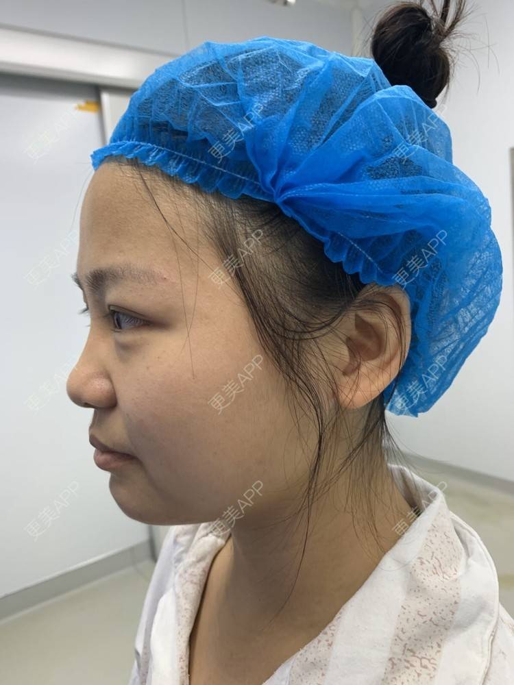 更美 - 变美找我~的肋软骨隆鼻经验 | 肋软骨隆鼻 | 鼻翼缩小 | 宁波 | 鼻孔矫正 | 眼部多项 | 自体肋软骨垫鼻基底