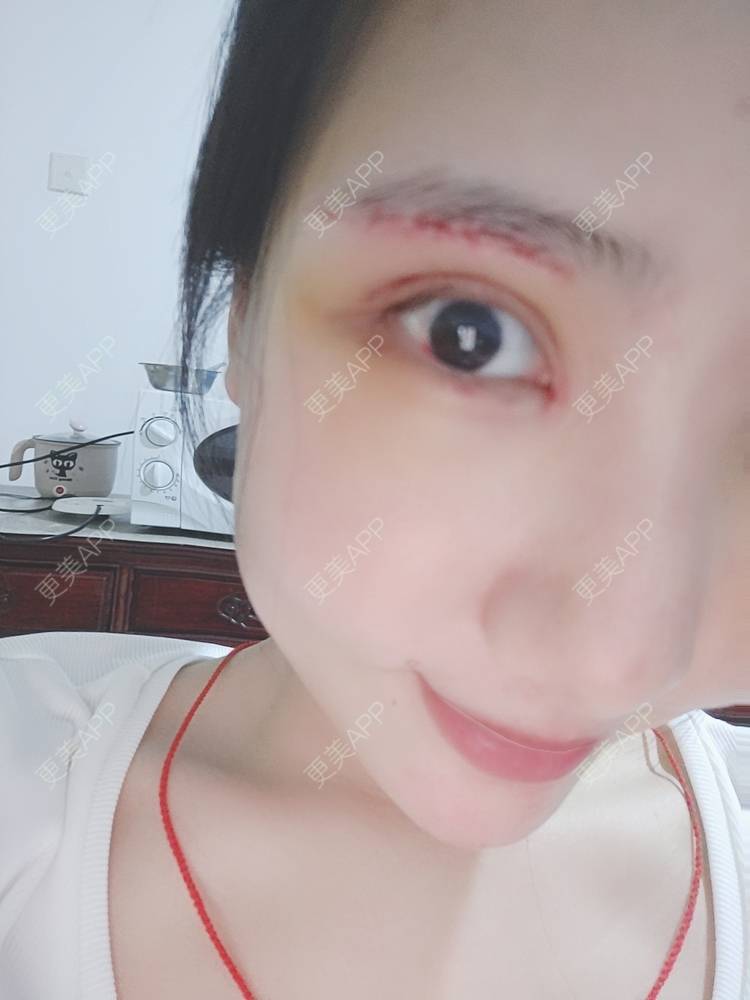 更美 - 更美用户R2vuT1w108的双眼皮修复经验 | 广州 | 双眼皮修复