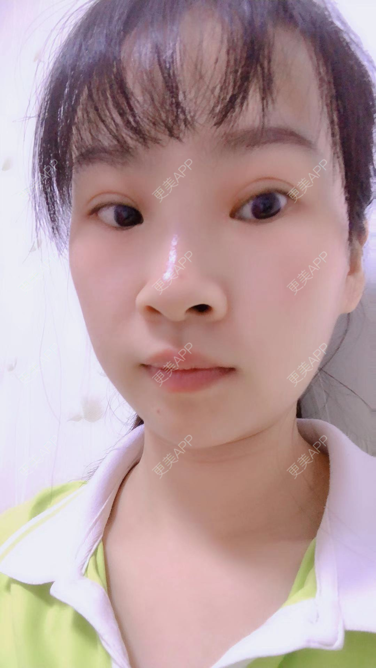 更美用户tZHepsylc0的双眼皮日记