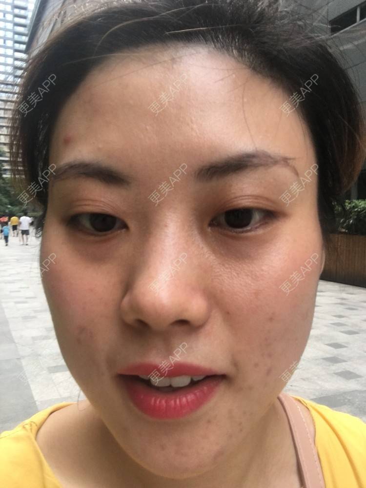 更美 - 更美用户Fbey21Pntj的祛斑祛色素经验 | 皮秒激光 | 改善肤质 | 广州 | 激光淡疤 | 激光淡斑