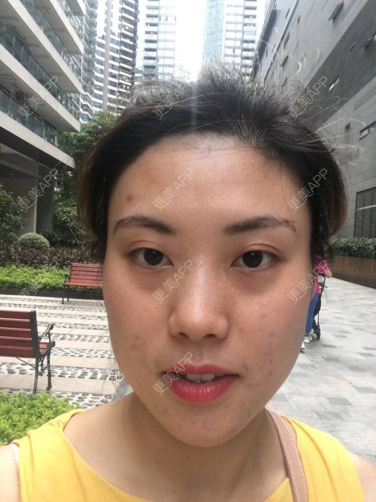 更美 - 更美用户Fbey21Pntj的祛斑祛色素经验 | 皮秒激光 | 改善肤质 | 广州 | 激光淡疤 | 激光淡斑