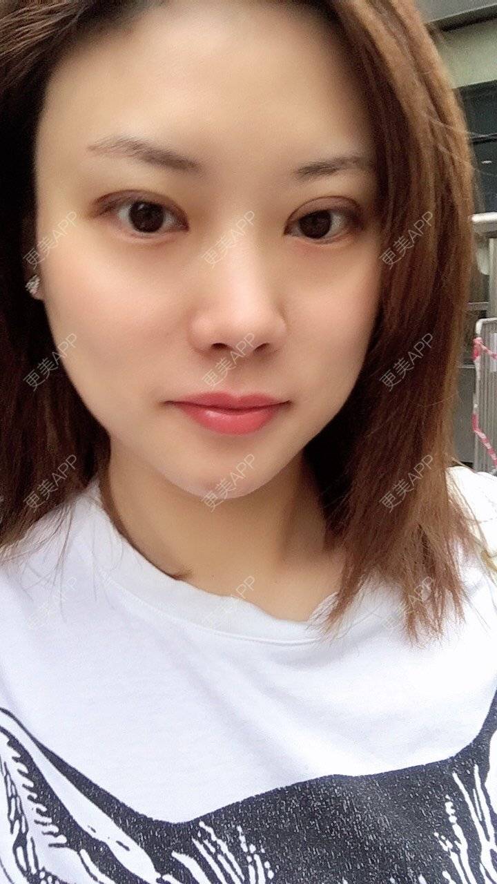 更美 - 更美用户Fbey21Pntj的祛斑祛色素经验 | 皮秒激光 | 改善肤质 | 广州 | 激光淡疤 | 激光淡斑