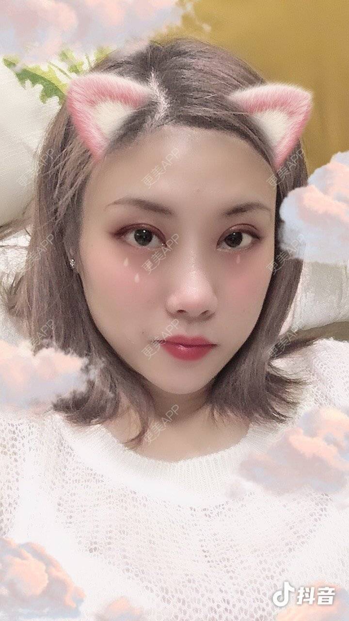 更美 - 更美用户Fbey21Pntj的祛斑祛色素经验 | 皮秒激光 | 改善肤质 | 广州 | 激光淡疤 | 激光淡斑