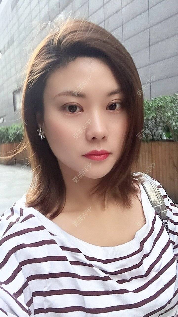 更美 - 更美用户Fbey21Pntj的祛斑祛色素经验 | 皮秒激光 | 改善肤质 | 广州 | 激光淡疤 | 激光淡斑