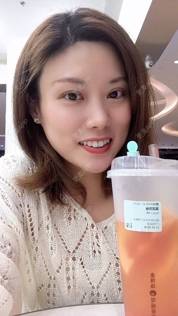 更美 - 更美用户Fbey21Pntj的祛斑祛色素经验 | 皮秒激光 | 改善肤质 | 广州 | 激光淡疤 | 激光淡斑
