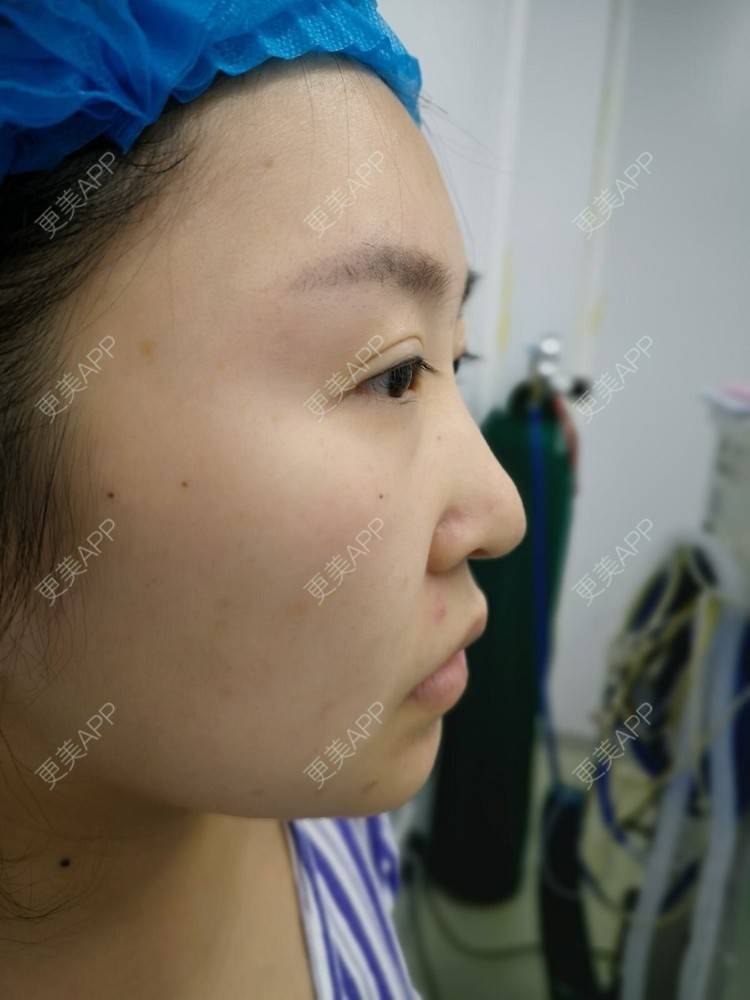 更美 - 变美找我~的肋软骨隆鼻经验 | 肋软骨隆鼻 | 鼻翼缩小 | 宁波 | 鼻孔矫正 | 眼部多项 | 自体肋软骨垫鼻基底