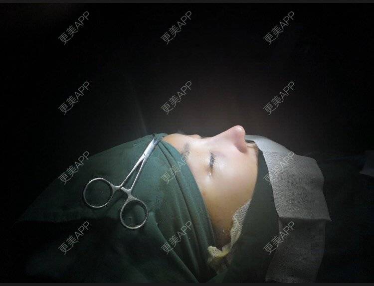 更美 - 变美找我~的肋软骨隆鼻经验 | 肋软骨隆鼻 | 鼻翼缩小 | 宁波 | 鼻孔矫正 | 眼部多项 | 自体肋软骨垫鼻基底