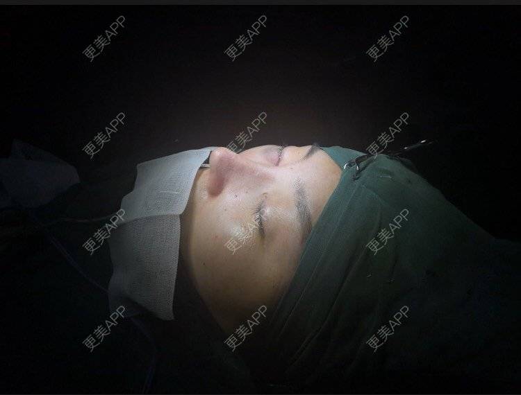 更美 - 变美找我~的肋软骨隆鼻经验 | 肋软骨隆鼻 | 鼻翼缩小 | 宁波 | 鼻孔矫正 | 眼部多项 | 自体肋软骨垫鼻基底