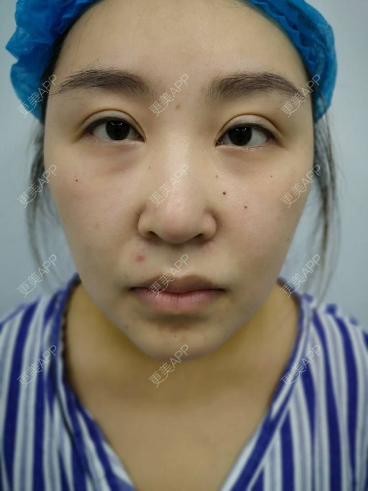 更美 - 变美找我~的肋软骨隆鼻经验 | 肋软骨隆鼻 | 鼻翼缩小 | 宁波 | 鼻孔矫正 | 眼部多项 | 自体肋软骨垫鼻基底