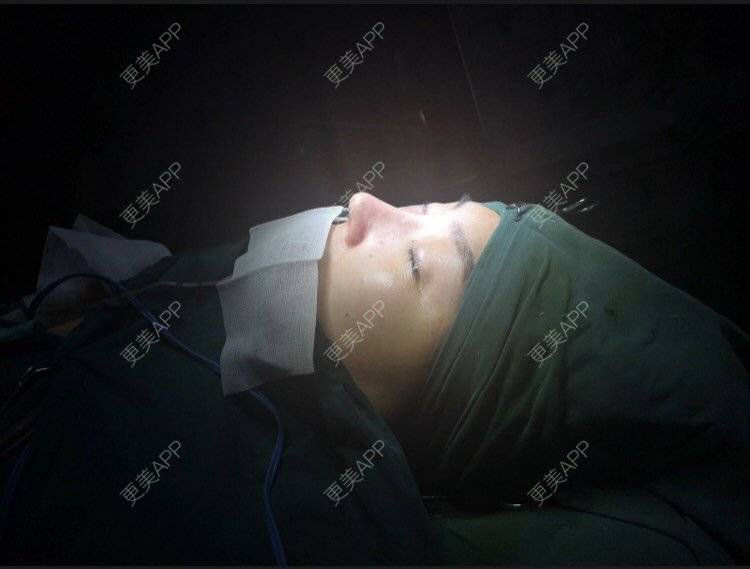 更美 - 变美找我~的肋软骨隆鼻经验 | 肋软骨隆鼻 | 鼻翼缩小 | 宁波 | 鼻孔矫正 | 眼部多项 | 自体肋软骨垫鼻基底