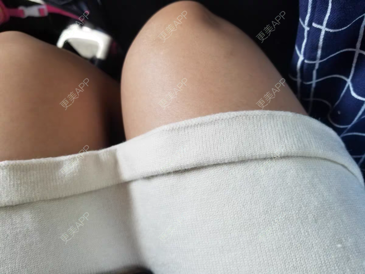 更美 - 雾，以类聚的阴蒂整形经验 | 上海 | 阴蒂整形