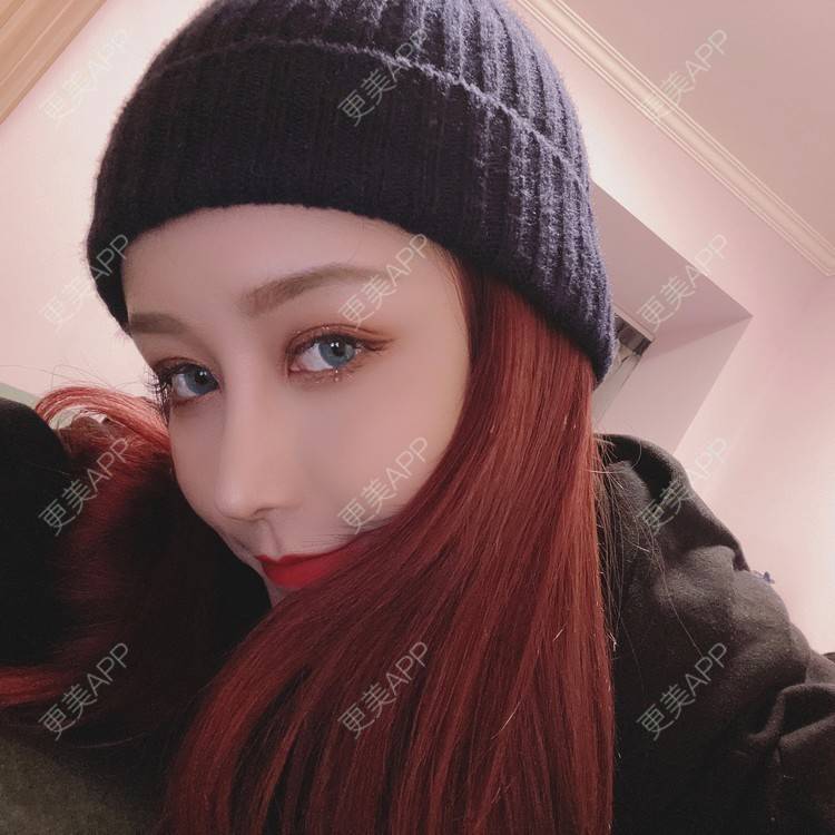 更美 - 端庄而又沉稳的我的鼻部多项经验 | 鼻部多项 | 鼻中隔软骨垫鼻头 | 自体软骨垫鼻尖 | 鼻小柱缩短 | 手术缩鼻头 | 膨体隆鼻 | 肋软骨隆鼻 | 鼻小柱延长 | 鼻部综合