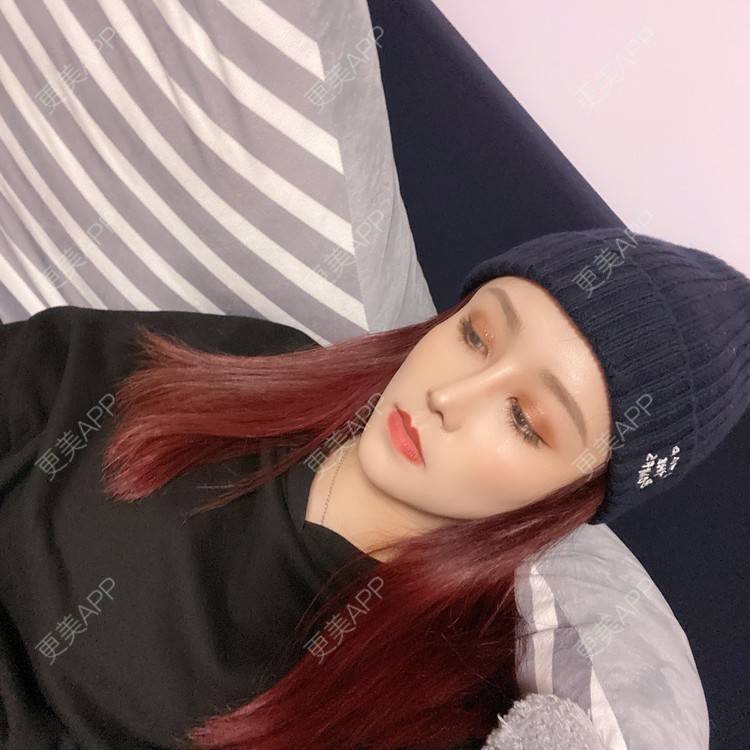 更美 - 端庄而又沉稳的我的鼻部多项经验 | 鼻部多项 | 鼻中隔软骨垫鼻头 | 自体软骨垫鼻尖 | 鼻小柱缩短 | 手术缩鼻头 | 膨体隆鼻 | 肋软骨隆鼻 | 鼻小柱延长 | 鼻部综合