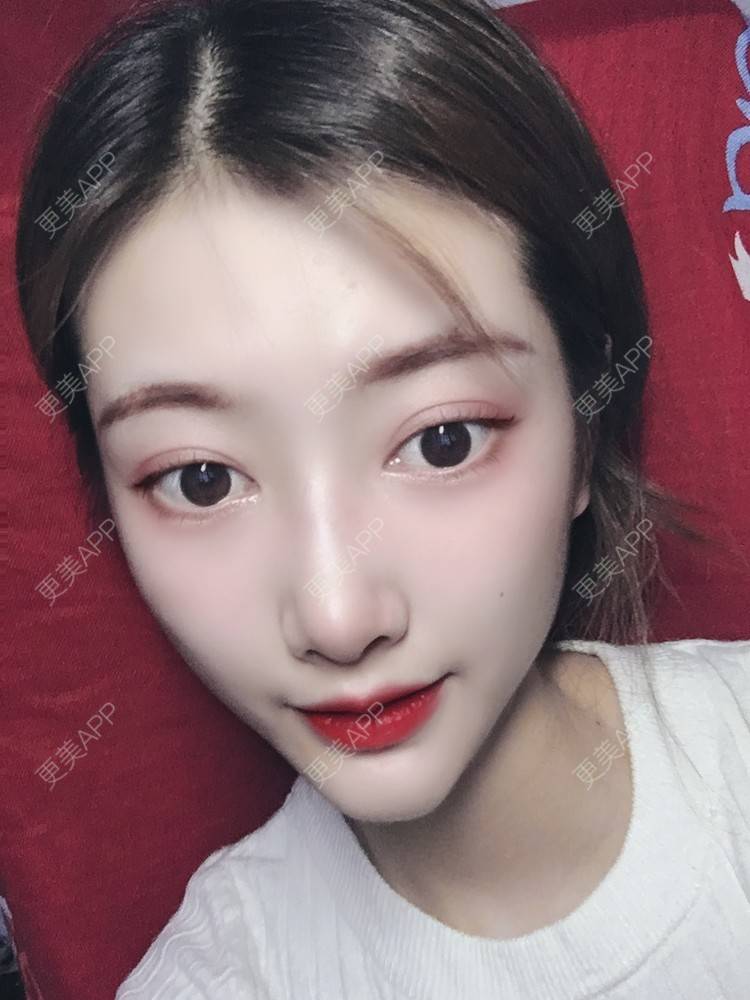 更美用户oslHm1ktZU的双眼皮日记