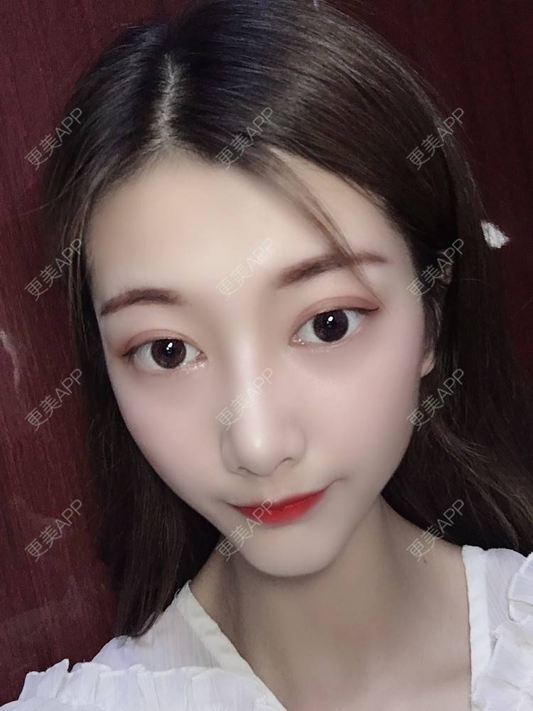 更美用户oslHm1ktZU的双眼皮日记