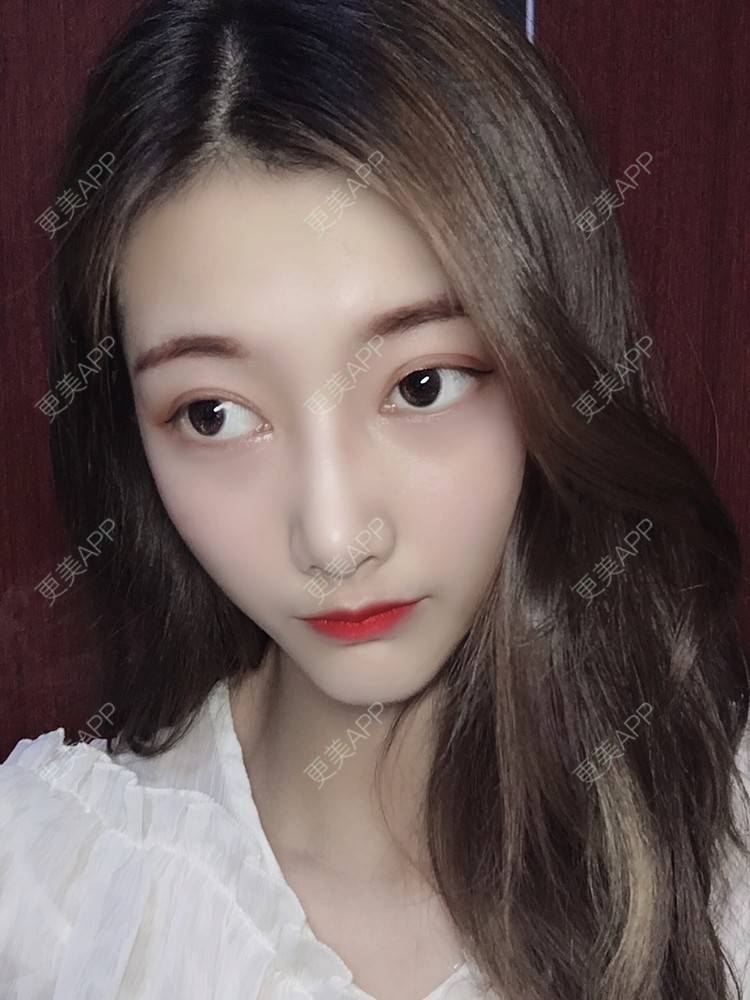 更美用户oslHm1ktZU的双眼皮日记