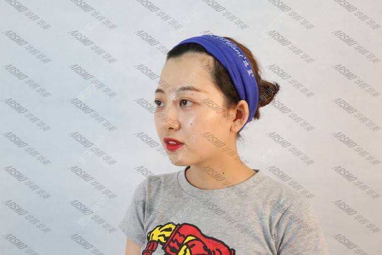 花花欧尼的皮秒激光日记