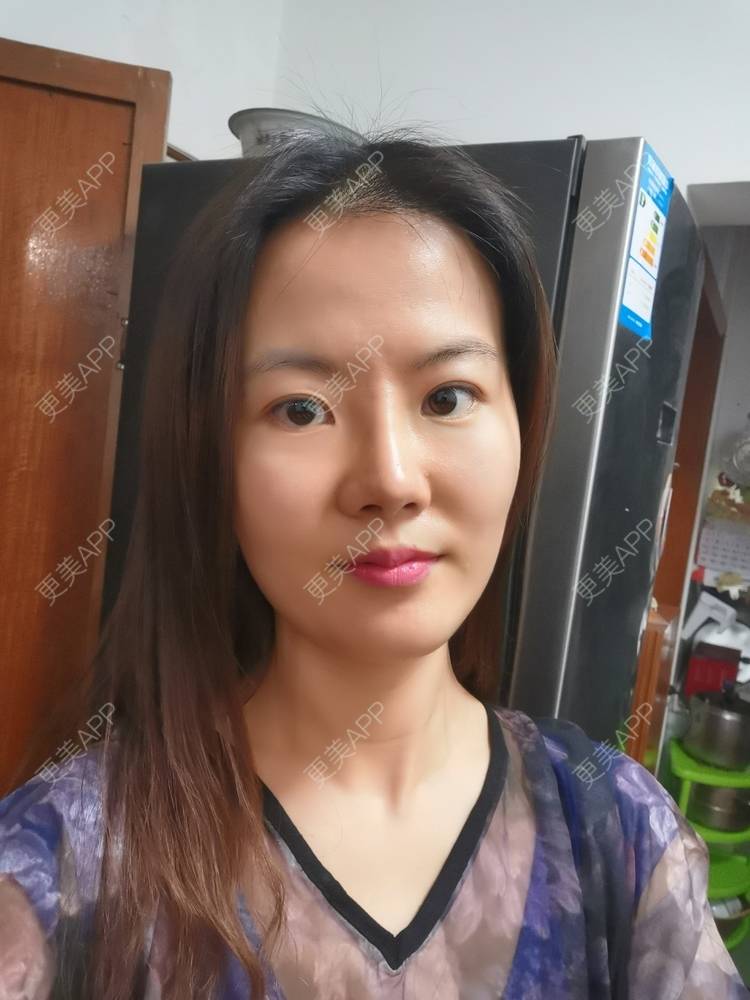 更美 - umgsd的植发际线经验 | 植发际线 | 上海