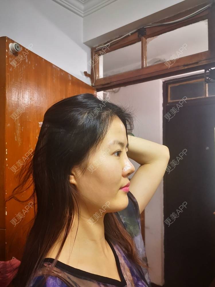 更美 - umgsd的植发际线经验 | 植发际线 | 上海