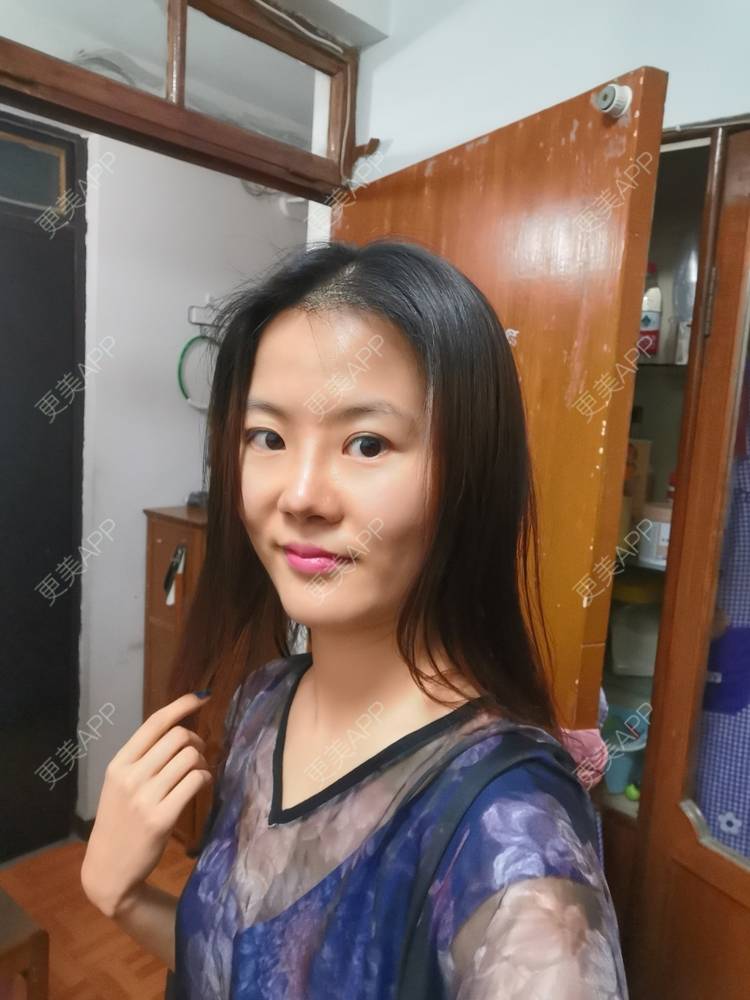 更美 - umgsd的植发际线经验 | 植发际线 | 上海