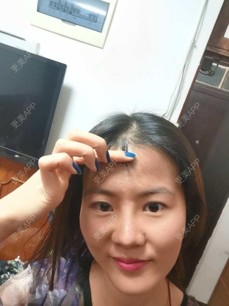 更美 - umgsd的植发际线经验 | 植发际线 | 上海