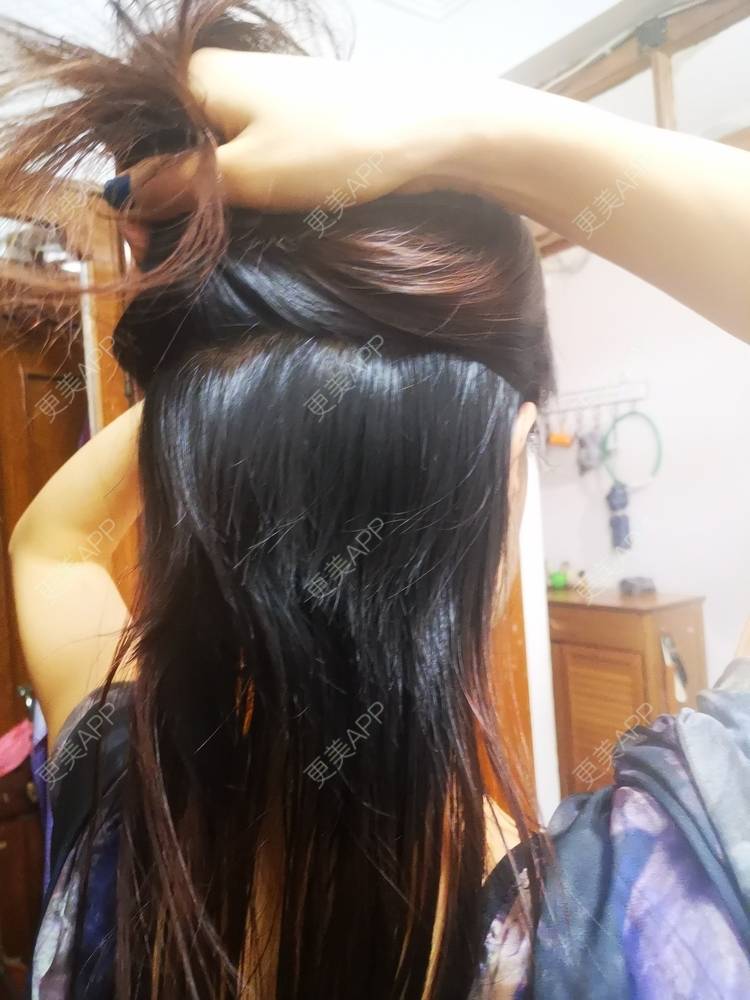 更美 - umgsd的植发际线经验 | 植发际线 | 上海