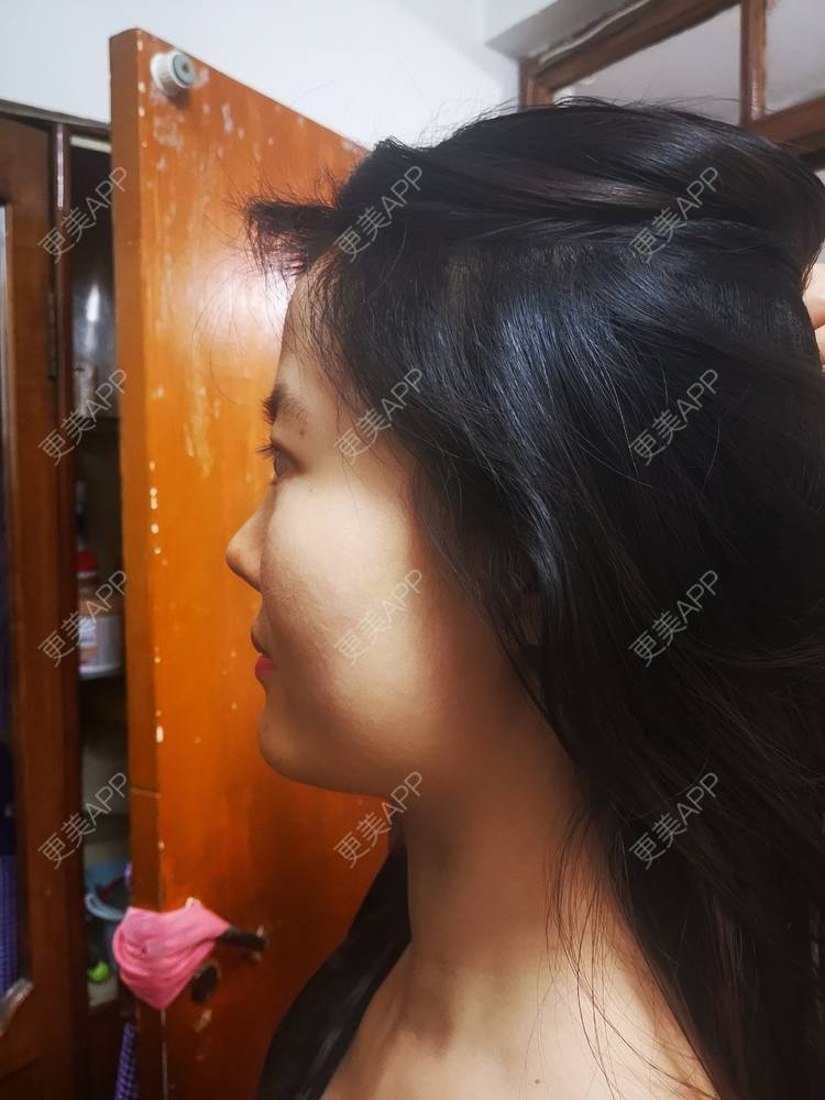 更美 - umgsd的植发际线经验 | 植发际线 | 上海