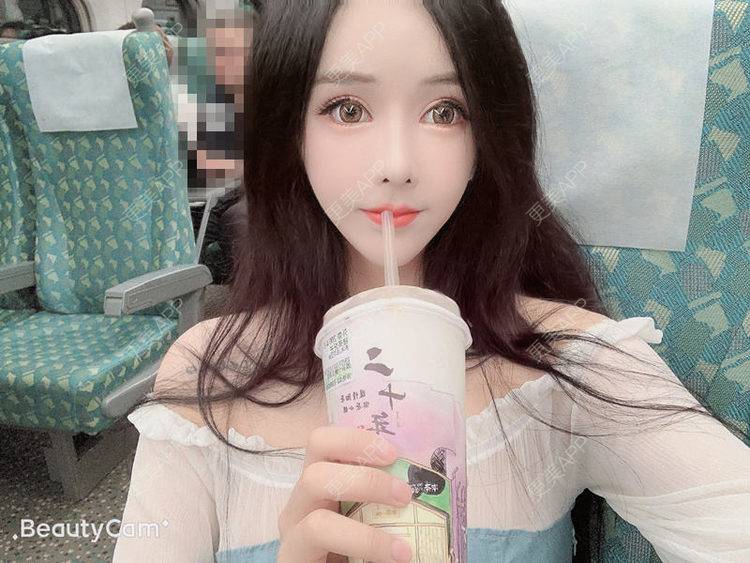 更美 - 小精玲的假体隆胸经验 | 视频日记 | 假体隆胸 | 深圳
