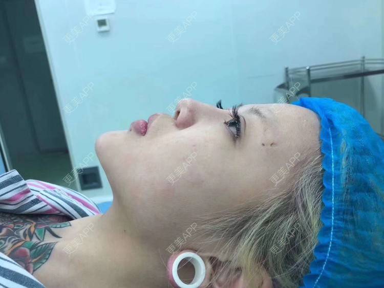 更美 - 变美找我~的肋软骨隆鼻经验 | 肋软骨隆鼻 | 鼻翼缩小 | 宁波 | 鼻孔矫正 | 眼部多项 | 自体肋软骨垫鼻基底