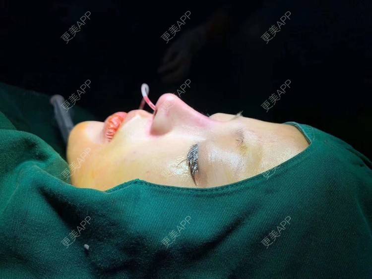 更美 - 变美找我~的肋软骨隆鼻经验 | 肋软骨隆鼻 | 鼻翼缩小 | 宁波 | 鼻孔矫正 | 眼部多项 | 自体肋软骨垫鼻基底