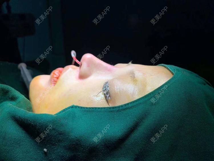 更美 - 变美找我~的肋软骨隆鼻经验 | 肋软骨隆鼻 | 鼻翼缩小 | 宁波 | 鼻孔矫正 | 眼部多项 | 自体肋软骨垫鼻基底