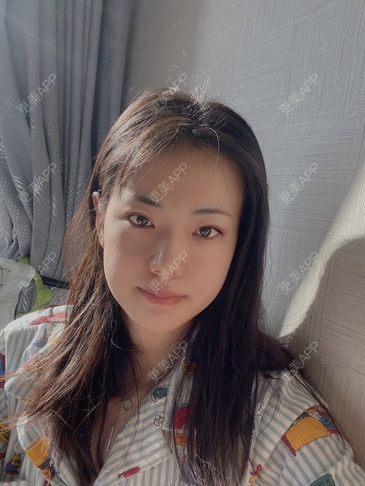 更美 - 菲儿好菇凉的双眼皮经验 | 定点双眼皮 | 埋线双眼皮 | 双眼皮 | 全切双眼皮 | 眼皮下垂矫正 | 重庆 | 上眼睑去脂 | 眼部多项