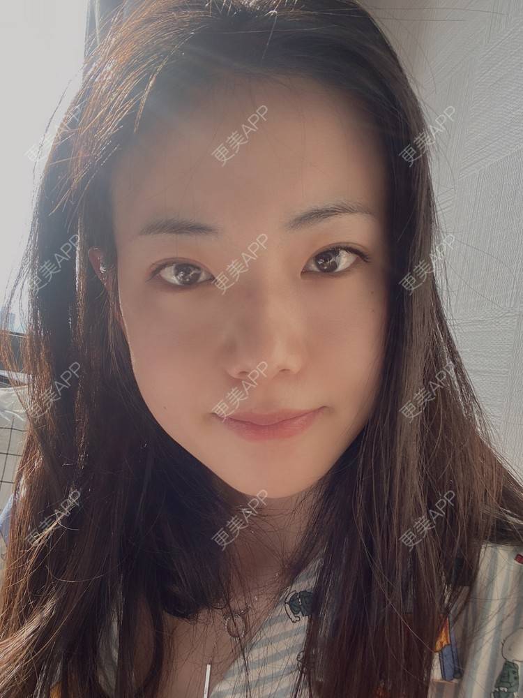 更美 - 菲儿好菇凉的双眼皮经验 | 定点双眼皮 | 埋线双眼皮 | 双眼皮 | 全切双眼皮 | 眼皮下垂矫正 | 重庆 | 上眼睑去脂 | 眼部多项