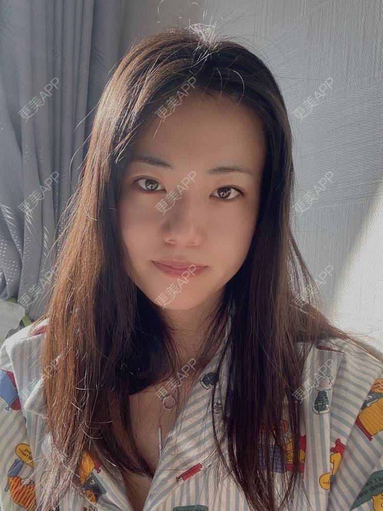 更美 - 菲儿好菇凉的双眼皮经验 | 定点双眼皮 | 埋线双眼皮 | 双眼皮 | 全切双眼皮 | 眼皮下垂矫正 | 重庆 | 上眼睑去脂 | 眼部多项