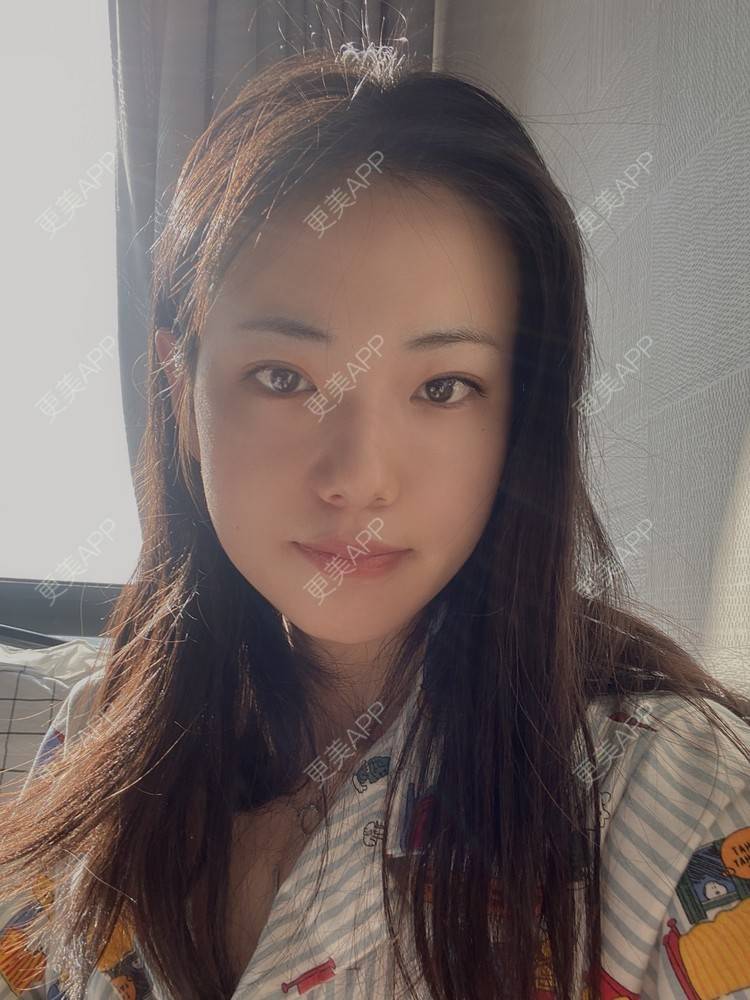 更美 - 菲儿好菇凉的双眼皮经验 | 定点双眼皮 | 埋线双眼皮 | 双眼皮 | 全切双眼皮 | 眼皮下垂矫正 | 重庆 | 上眼睑去脂 | 眼部多项