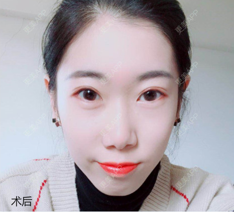 更美 - 贺建平 医生的双眼皮经验 | 双眼皮