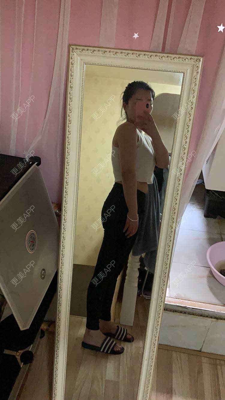 更美 - 李文雅施的吸脂去副乳经验 | 吸脂去副乳 | 吸脂 | 上海