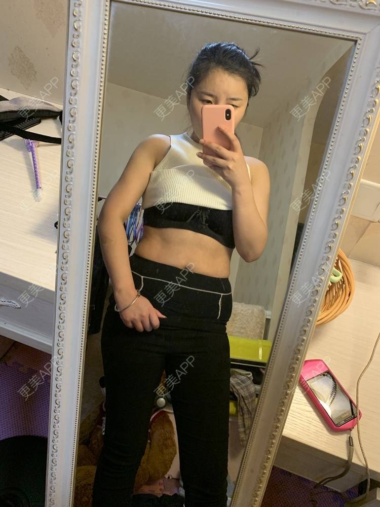 更美 - 李文雅施的吸脂去副乳经验 | 吸脂去副乳 | 吸脂 | 上海