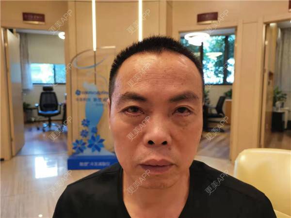 更美 - 更美用户IG0lQLfUjW的外切去眼袋经验 | 杭州 | 外切去眼袋